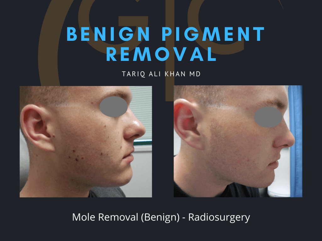 Gentle Care Laser Tustin Before and After picture - Mole Removal